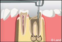 traitement radiculaire