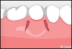 Chirurgie mucogingivale